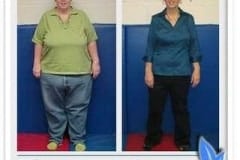 Before & after gastric sleeve