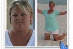 Bariatric surgery before & after