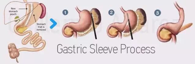 Gastric Sleeve Process in Mexico