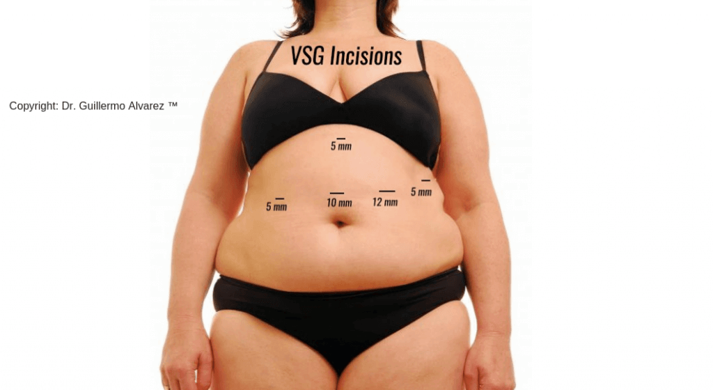 Vertical sleeve gastrectomy incisions