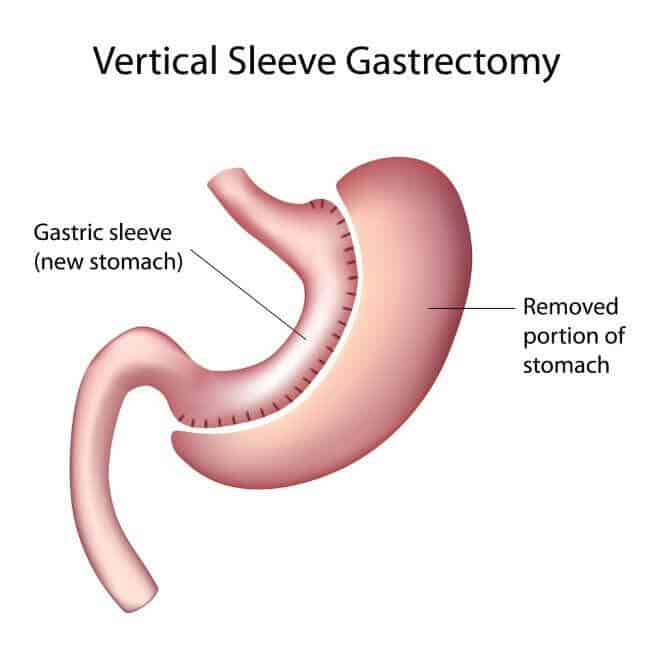 Vertical Sleeve Gastrectomy in Mexico