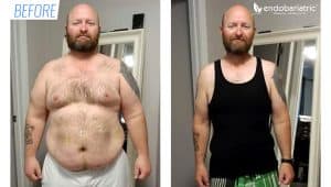 Endobariatric Before and After Mexico