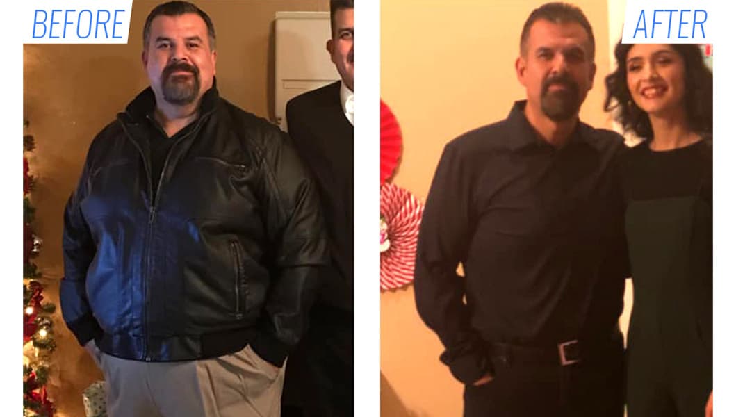 Gastric Sleeve Before and After Mexico