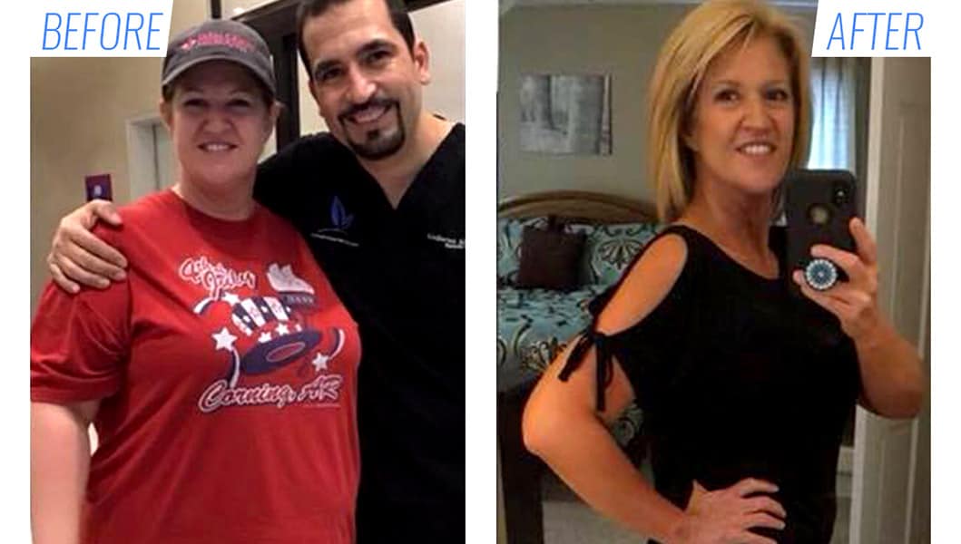 Before & after gastric sleeve surgery in Mexico