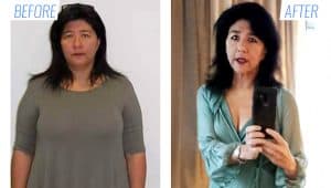 Gastric Sleeve vs. Gastric Lap Band Mexico