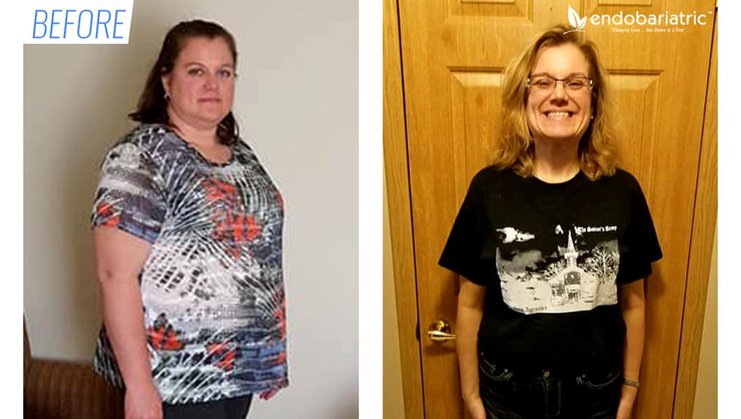 Before & after gastric sleeve surgery