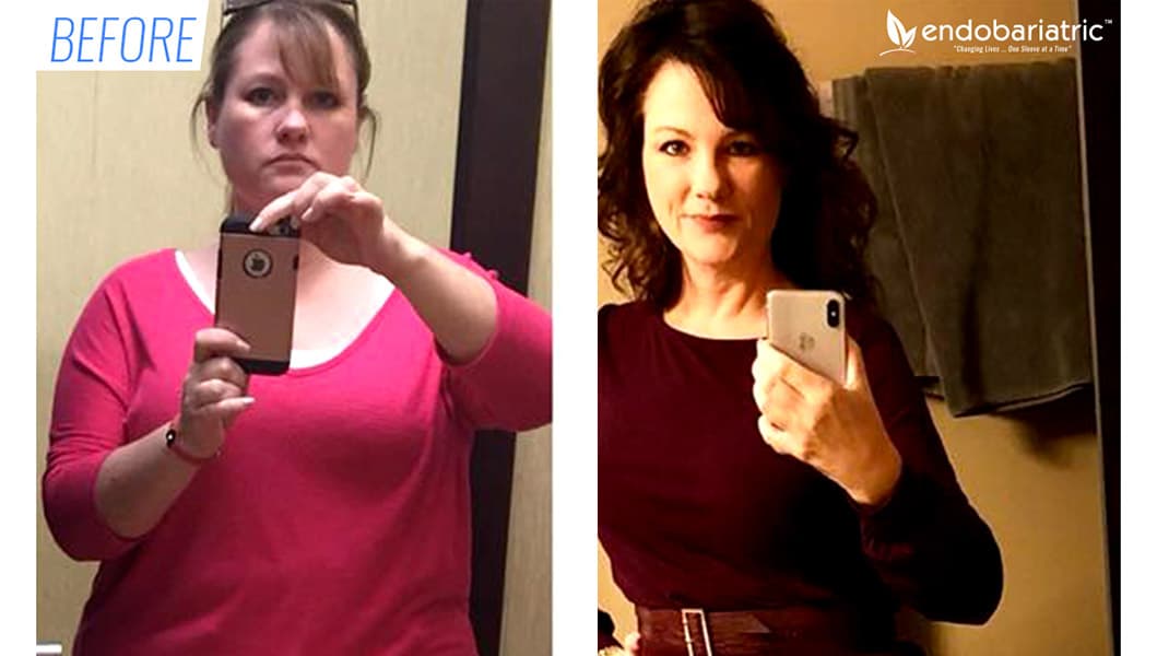 Before & after gastric sleeve surgery in Mexico