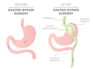 Gastric Bypass Surgeon Mexico