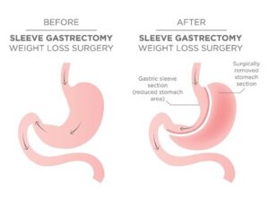Sleeve Gastrectomy Mexico