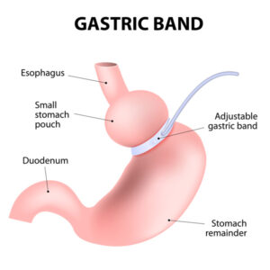 Gastric Band Mexico