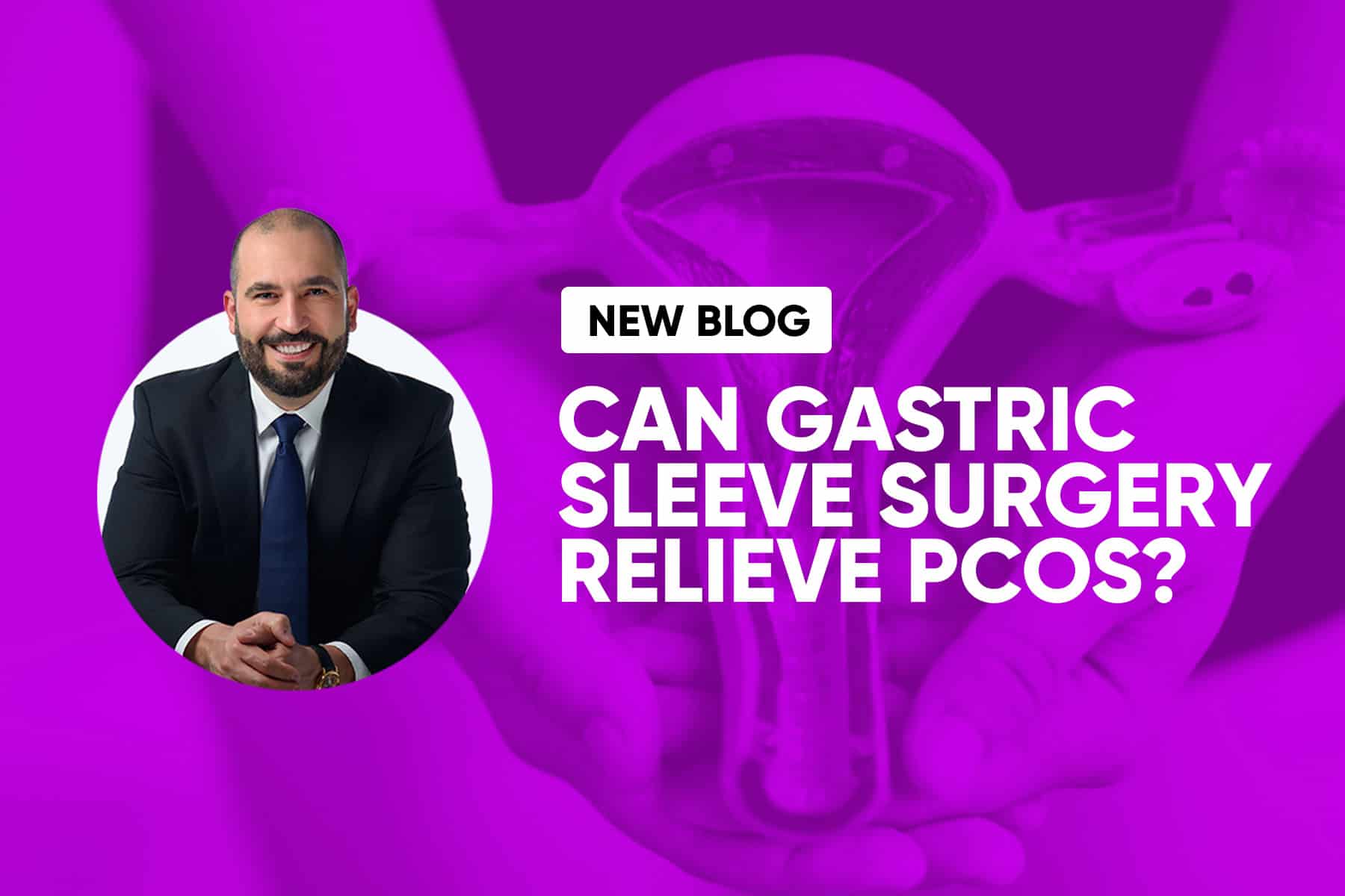 Can Gastric Sleeve Surgery Relieve PCOS?